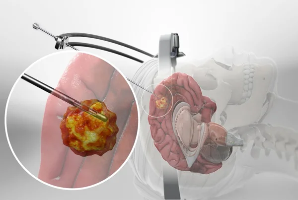 Cranial Stereotactic Procedures