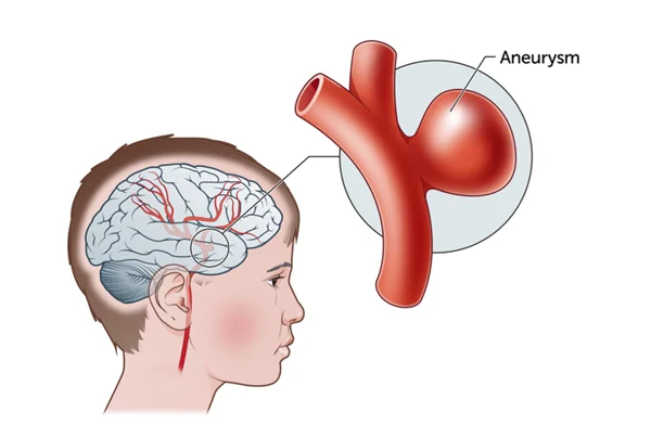 Aneurysm