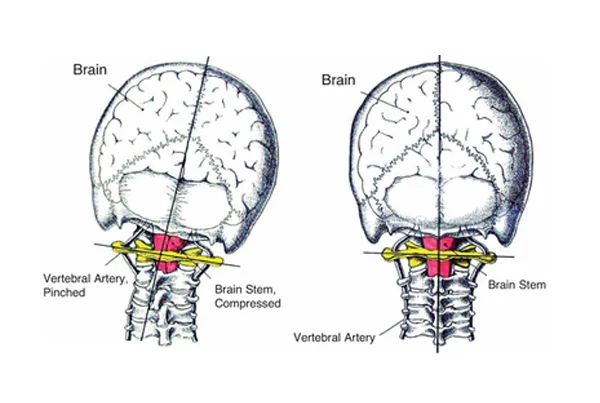 Craniovertebral Junction Anomalies
